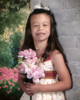 Syndrome williams expectancy symptoms william facts child byebyedoctor Hudya Nelfia: WILLIAM SYNDROME