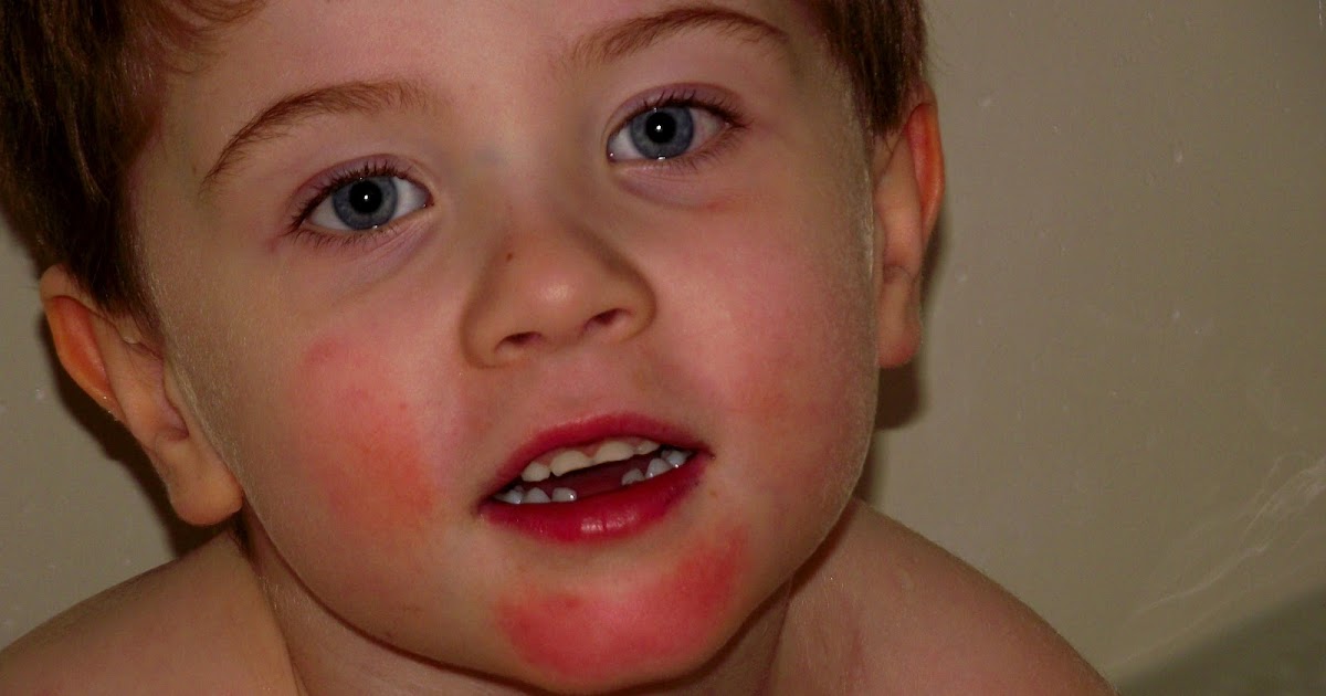 Momma Melly Gluten Intolerance Rashes & Symptoms!