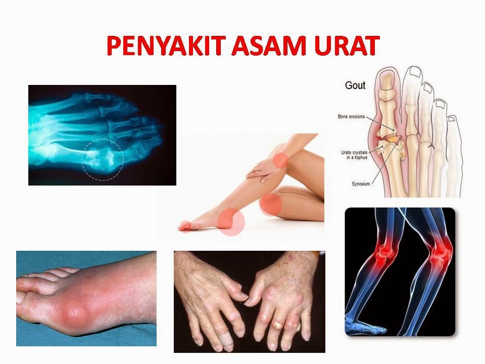 Obat Asam Urat Allopurinol Dan Cara Mengetahui Kadar Asam Urat 