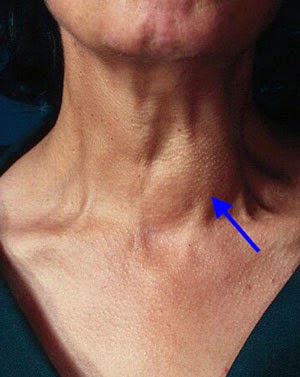 cara mengobati tumor jinak di leher http://infoprodukgreenworld.blogspot.com/2015/04/cara-mengobati-tumor-jinak-di-leher.html