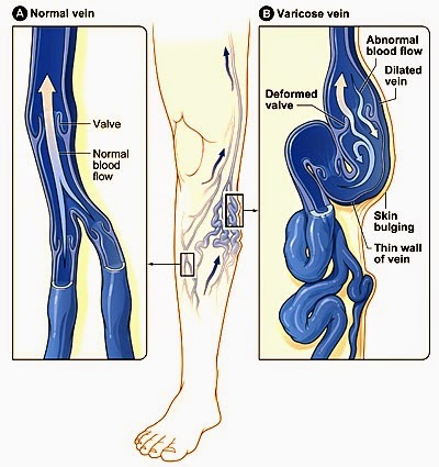 salur darah masalah urat kaki timbul
