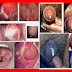 Obat Pasutri Yang Terkena GONORE thumbnail