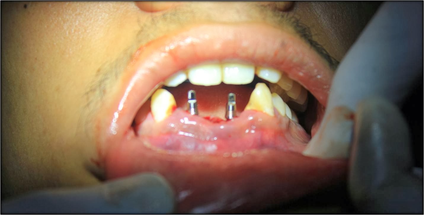 LOOSE BOTTOM FRONT TEETHTreatment by affordable dental implants and