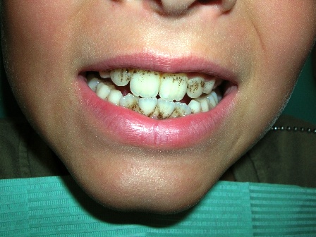 before polish scale scaling root importance planing planning dentist paphos demetriou elena