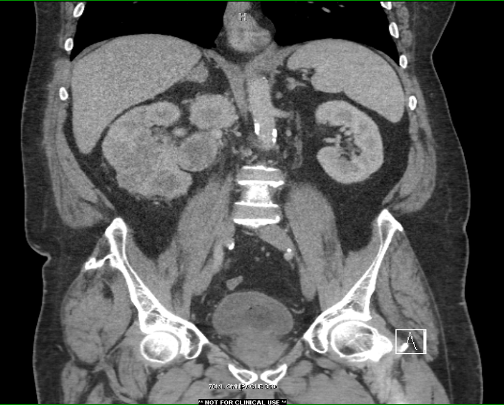 Brady Urology at Johns Hopkins Hospital Lymph Node Dissection for