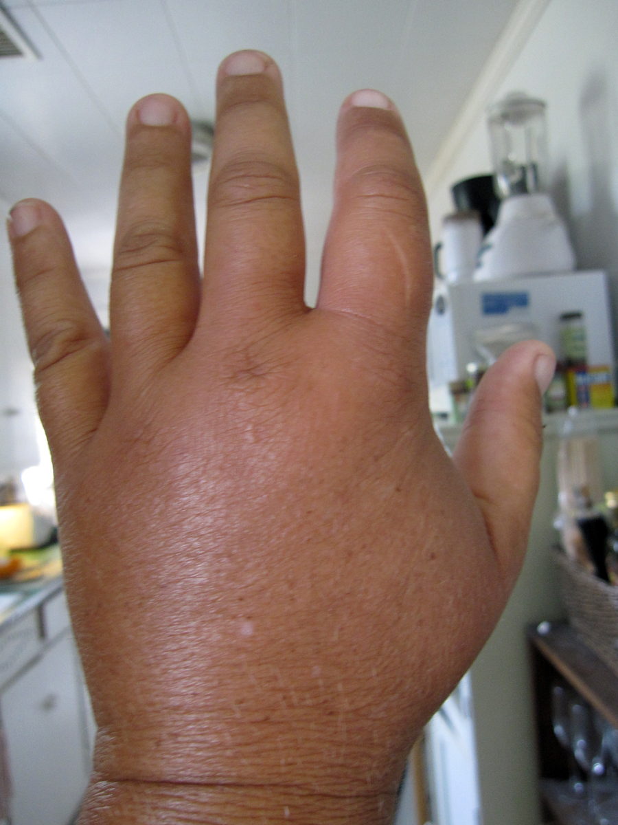 Sensuality84 got mad and punched a wall, now she can't type. She thinks