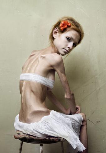 Anorexia In Art