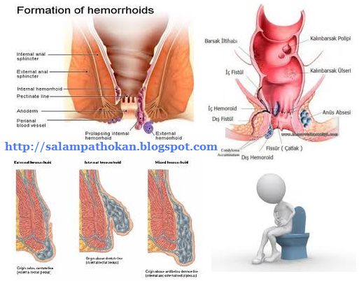 Hemorrhoid herpes anus