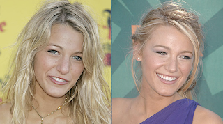 Blake Lively on Blake Lively Before After Plastic Surgery Png