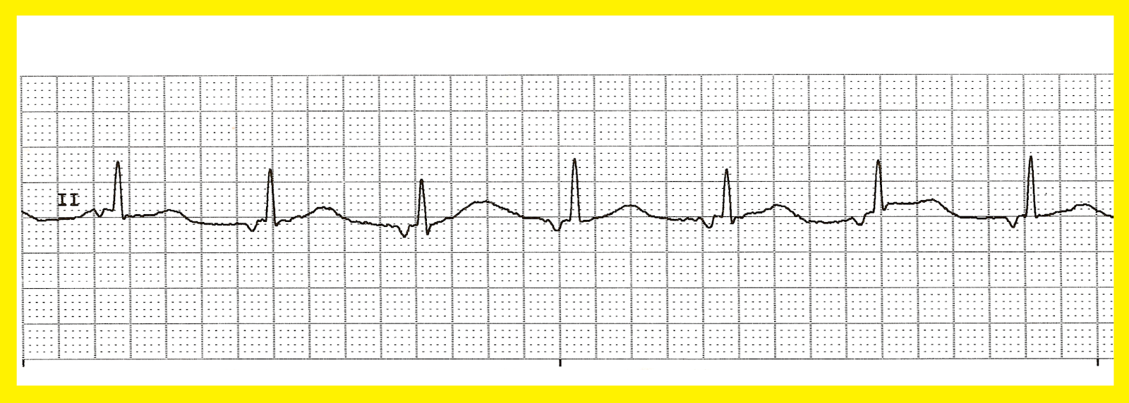 Float Nurse Various Accelerated Junctional Rhythms