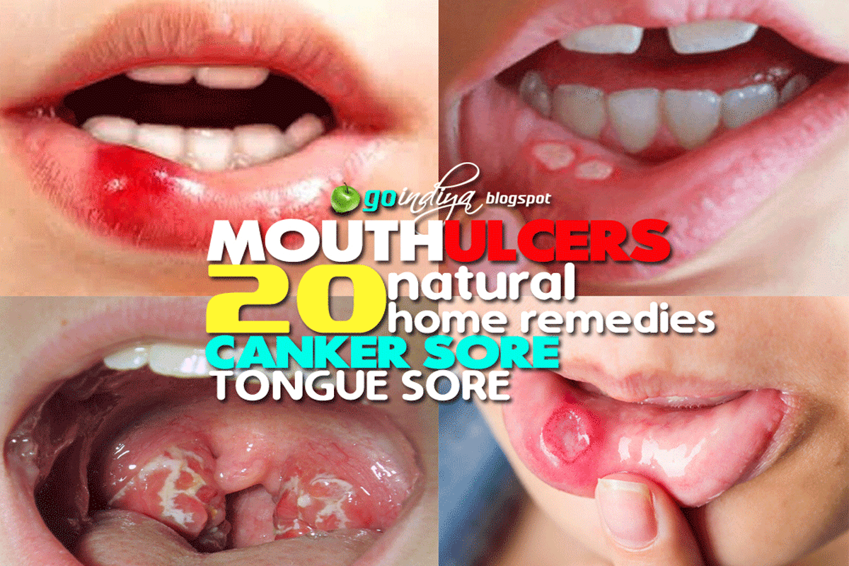 Watch Soothe Canker Sores video Watch Soothe Canker Sores video