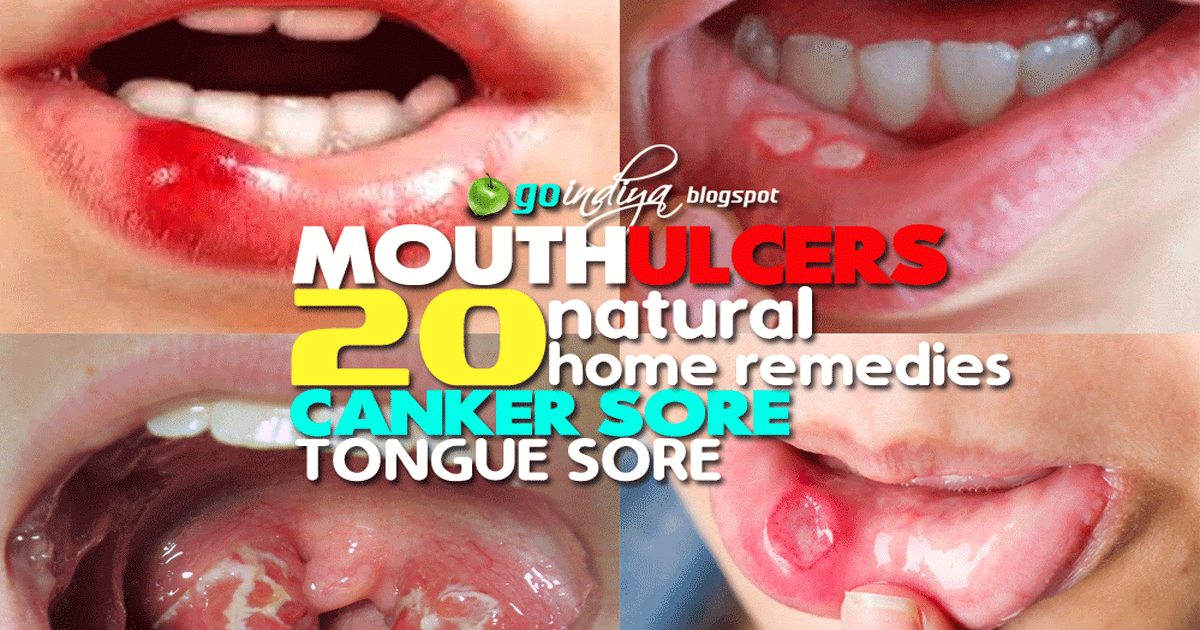 Mouth Ulcers (Canker sore/Tongue Sore) 20 Best Home Remedies for Fast
