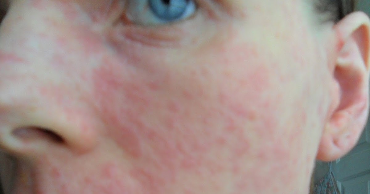 I Have Eczema Eczema Herpeticum No.8