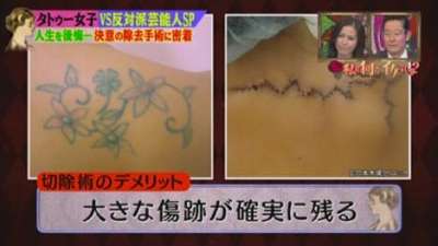 tortuosa remoção de tatuagem no Japão