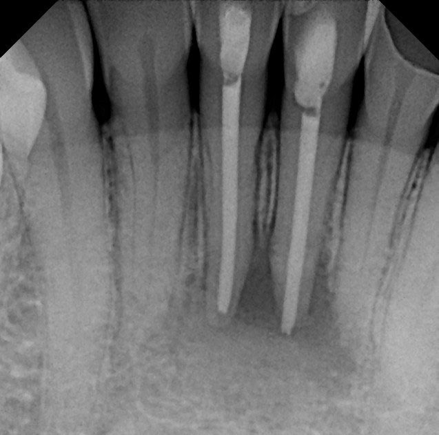 The Endo Blog Success with endodontic surgery (apicoectomy)