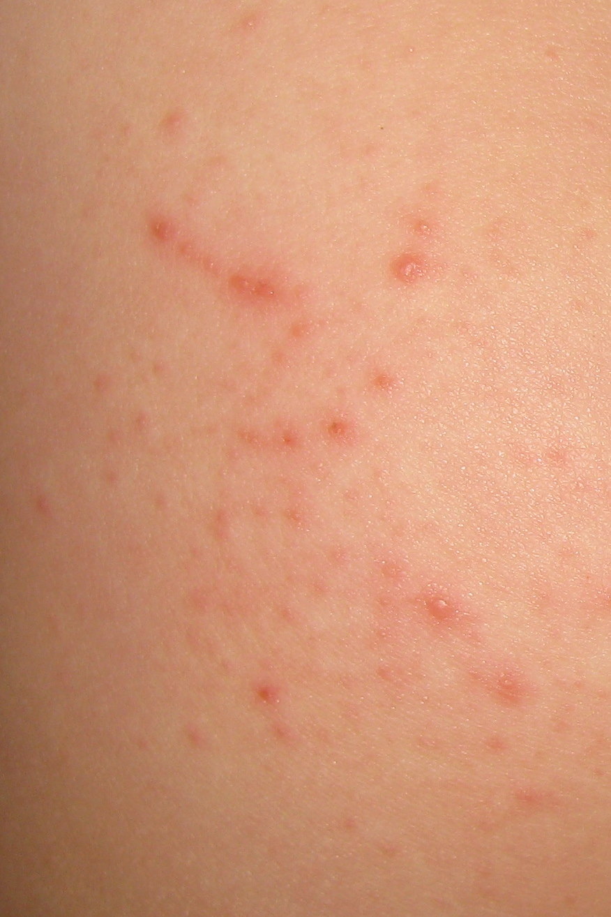 Gluten Sensitivity Rash