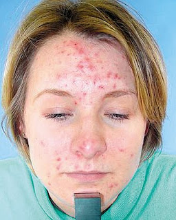 Conseils pour mettre fin à l'acné adulte