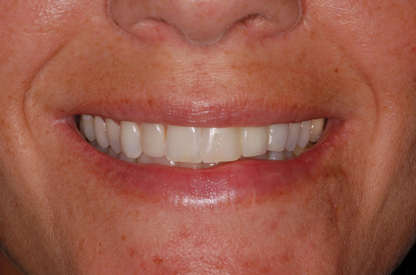 Dental flipper choices What are your options? What's cost?