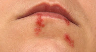 Pictures of Cold Sore