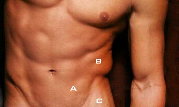 人魚線, 膨脹麻醉抽脂, tumescent liposuction 人魚線, 膨脹麻醉抽脂, tumescent liposuction
