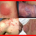 Ramuan Obat Tradisional Herpes thumbnail