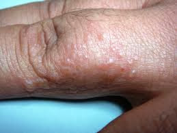 picture of Dyshidrotic Eczema