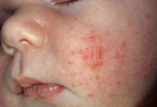 BỆNH VIÊM DA TIẾT BÃ Ở TRẺ EM
