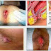 Obat Anti Buang Air Besar Berdarah Selain AMBEVEN thumbnail