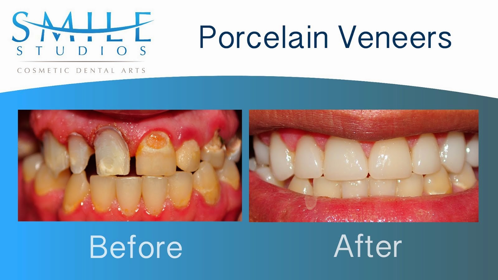 Porcelain Veneers