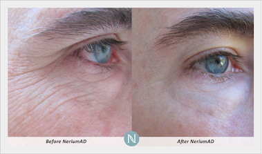 NeriumAD