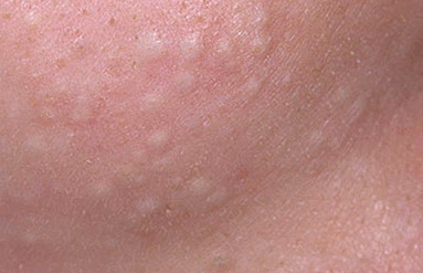 How To Safely Get Rid Of Whiteheads How To Safely Get Rid Of Whiteheads