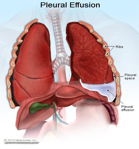 pleurisy lung sounds