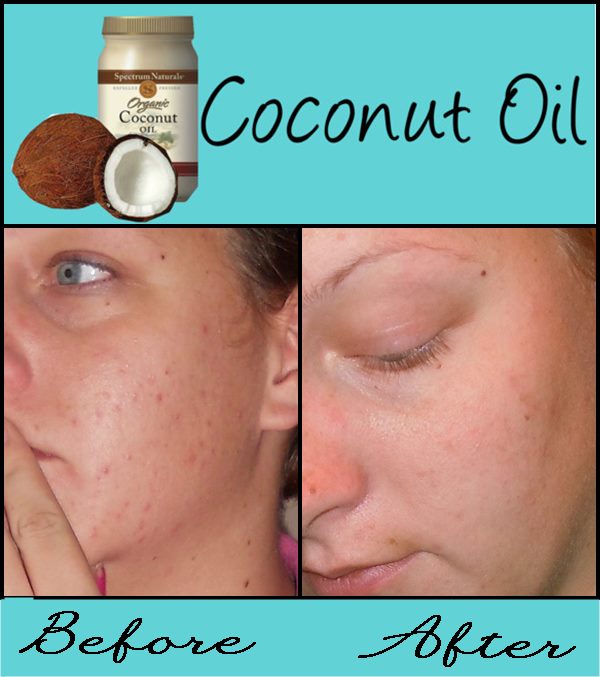 Southern Styled Coconut Oil Theory Skin Care Update with Before and