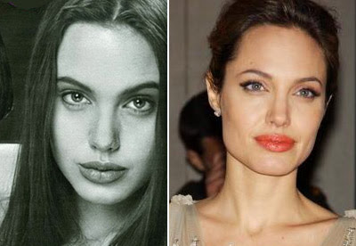 Angelina Jolie Plastic Surgery Before And After