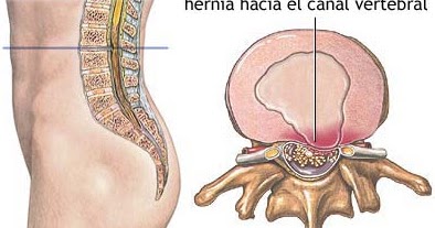 Los dolores en la espalda ante mensual las causas