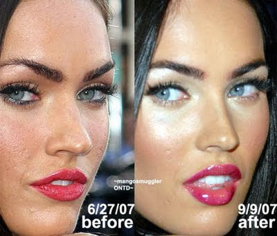 Megan Fox plastic surgery