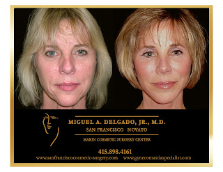 facelift napa county facelift napa county