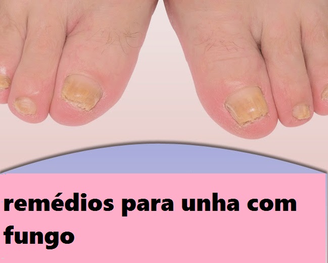 Bandejas com iodo de um fungo de pé