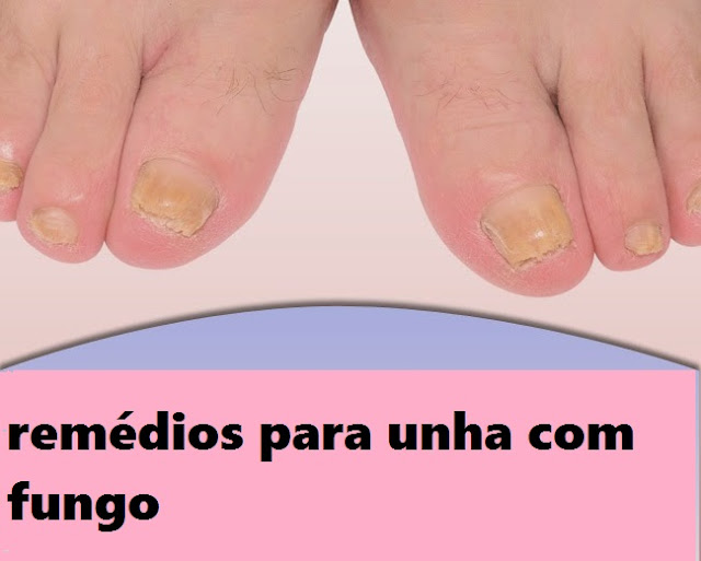 Unguento de um fungo em pele da mão