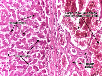 Histology and explanation of Cavernous hemangioma liver