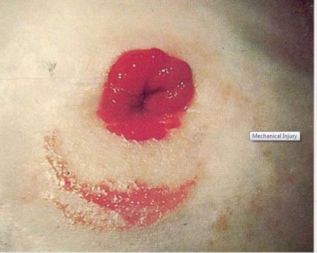 mechanical injury