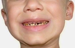 Underbite chez les enfants