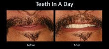 teeth in a day teeth in a day austin dental implant center