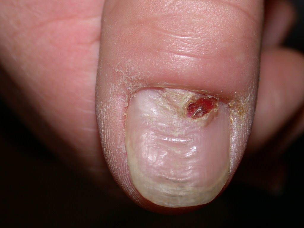 Damaged Nail Cuticle Best Designs 2018 Everythinghealth Answer To Yesterdays Medical Challenge
