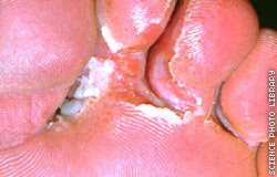Natural Athletes Foot Cure Tea Tree Natural Athletes Foot Cure Tea Tree