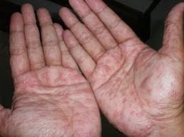 Telapak tangan gatal didalam kulit | Cara mengobati Gatal Eksim Selakangan