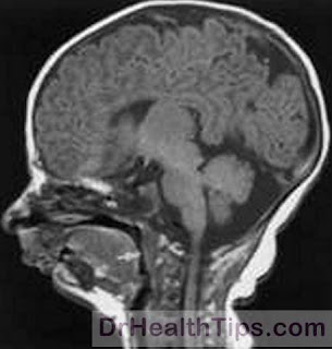 Skull radiology in Micrognathia