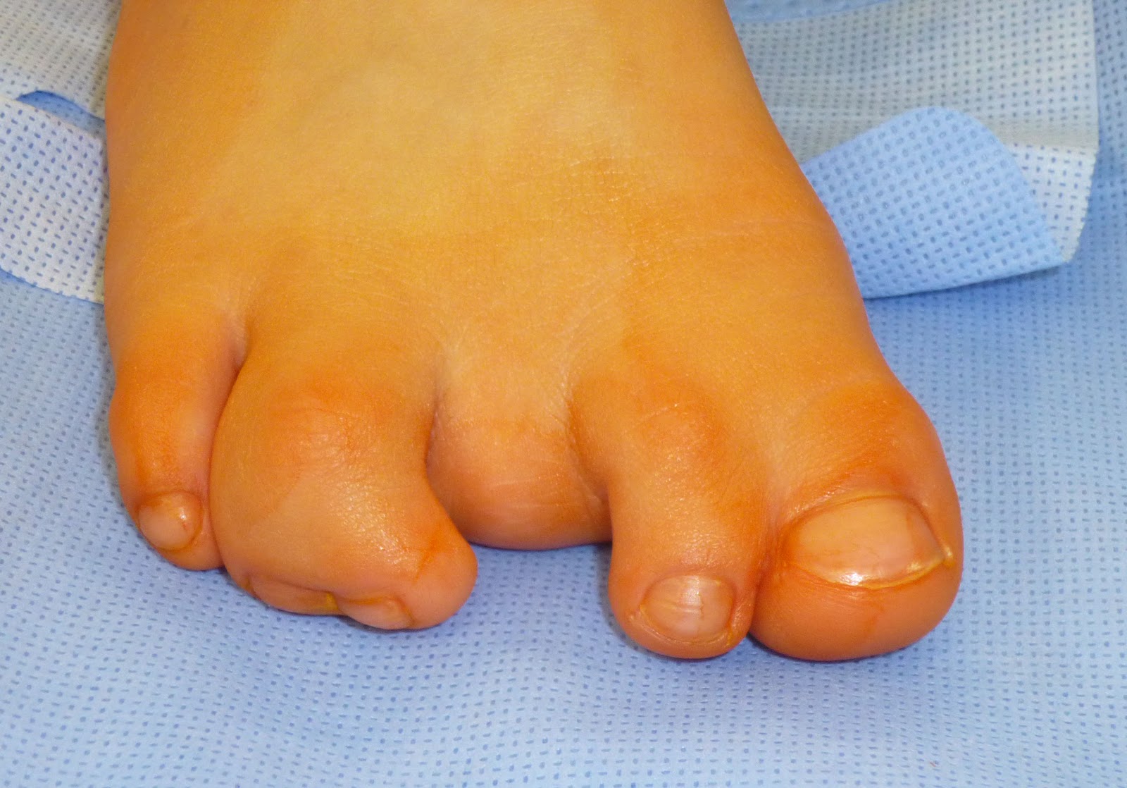 Toes and Toestumps #amputee #toe