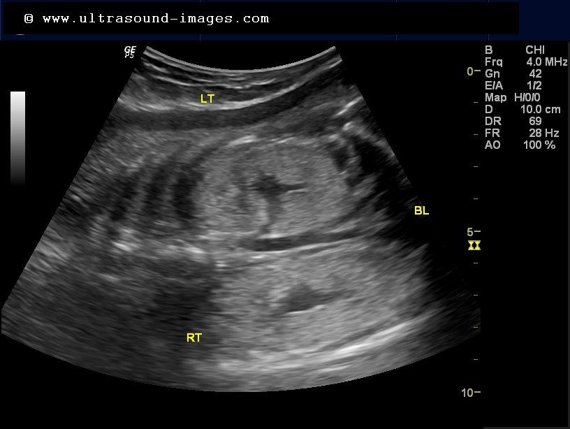 cochinblogs Quiz fetal kidneys in 34 weeks pregnancy