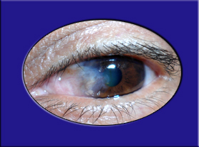 Carnosidad de los ojos (Pterigión)